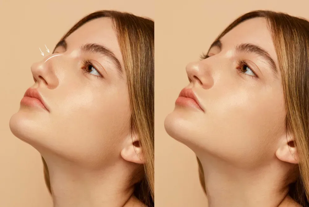 Rinoseptumplastia funcional y estética